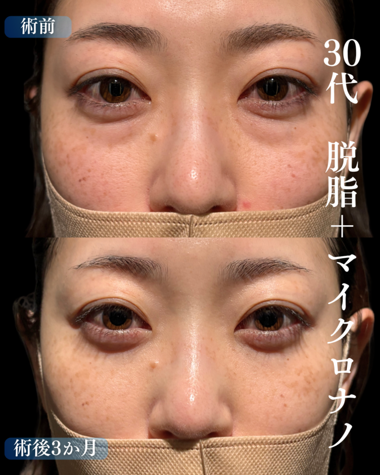 30代女性　脱脂+脂肪注入